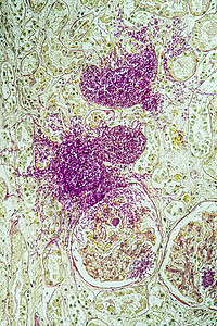 携带真菌Candida生长200x的艾滋病组织调查治愈组织学康复诊断科学免疫药品病理检查图片