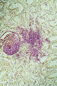 携带真菌Candida生长200x的艾滋病组织诊断病理检查组织学科学药品治愈免疫康复调查图片