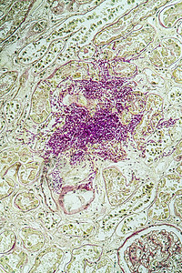 携带真菌Candida生长200x的艾滋病组织病理诊断宏观检查调查缺陷科学疾病免疫组织学图片