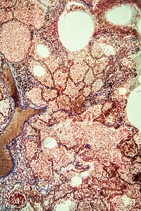 显微镜下的肺结核组织 100x病机病理学细胞宏观结核科学棕色疾病肺部背景图片