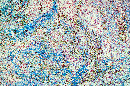 显微镜下外体颗粒瘤组织 100x细胞科学疾病放大镜巨细胞蓝色异物皮肤宏观病变图片
