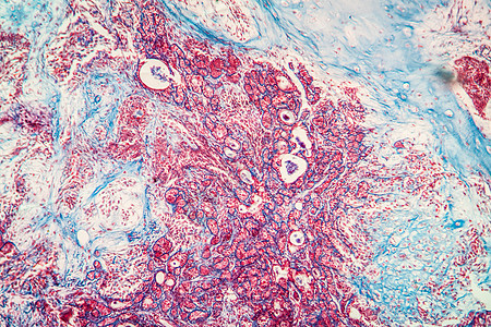 100x 疾病组织100x宏观细胞腮腺纤维病理科学皮细胞放大镜上皮增殖图片
