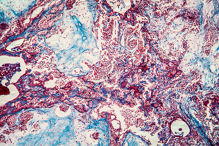 100x 疾病组织100x病理放大镜纤维科学上皮癌症细胞宏观增殖皮细胞图片