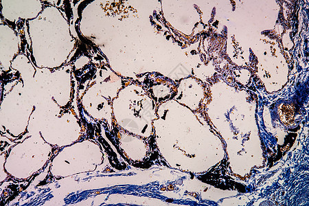 显微镜下的炭粉尘肺组织 100x肺部矿工科学潜水肺炎宏观药品报告细胞蓝色图片