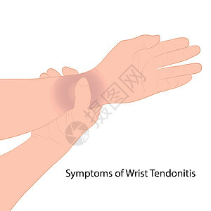 图像图形矢量轮廓手腕疼痛通常是由突然受伤概念保健引起的扭伤或骨折引起的诊所骨头茎突医师菌株韧带身体教育插图手臂图片