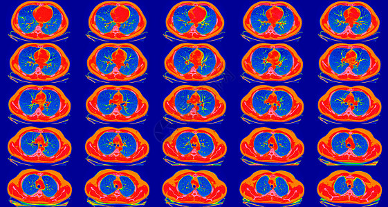正常的肺部扫描 光谱摄氏度 可能是COVID19诊断的一部分 COVID19躯干身体成人疾病辐射器官胸部医院解剖学呼吸图片