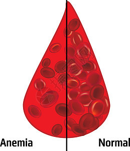 贫血和正常红血细胞沉积诊断治愈血液学红细胞愈合疾病诊所实验室血细胞验血图片