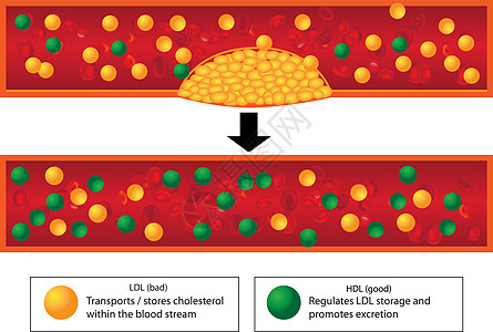 鲜血容器中好的和坏的脂质的作用以及无神水力标志板的水平图片