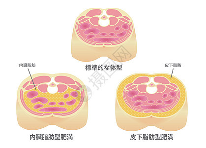 日本的肥胖插图类型 腹部剖视图 内脏脂肪 皮下脂肪身体横截面医疗男性药品数字卫生糖尿病科学饮食图片