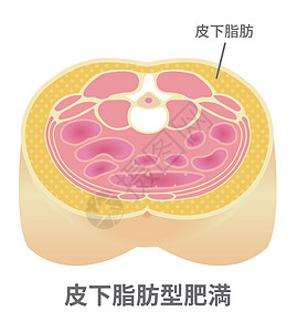 日本的肥胖插图类型 腹部剖视图皮下脂肪疾病身体糖尿病重量医疗男性代谢生物学科学数字图片