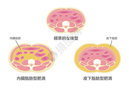 日本的肥胖插图类型 腹部剖视图 内脏脂肪 皮下脂肪器官糖尿病保健损失疾病代谢重量数字科学男性图片