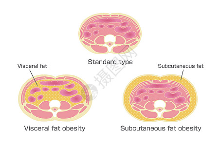 日本的肥胖插图类型 腹部剖视图 内脏脂肪 皮下脂肪代谢饮食身体男人卫生横截面药品损失糖尿病生物学图片