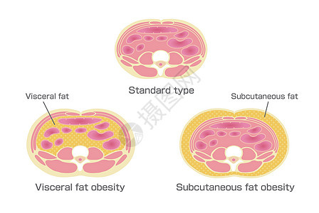 日本的肥胖插图类型 腹部剖视图 内脏脂肪 皮下脂肪代谢饮食身体男人卫生横截面药品损失糖尿病生物学图片