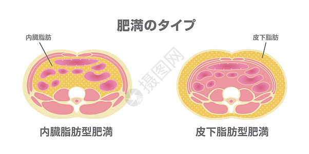 日本的肥胖插图类型 腹部剖视图 内脏脂肪 皮下脂肪器官卫生饮食重量生物学男性男人疾病医疗横截面图片