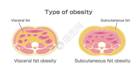 日本的肥胖插图类型 腹部剖视图 内脏脂肪 皮下脂肪男性身体卫生糖尿病疾病保健生物学数字科学重量图片