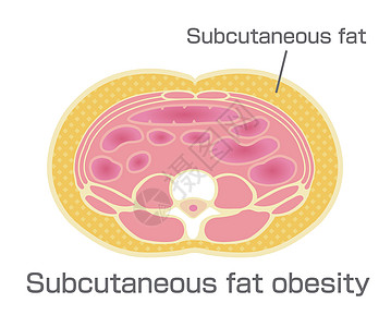日本的肥胖插图类型 腹部剖视图皮下脂肪数字器官饮食药品代谢医疗科学损失生物学疾病图片
