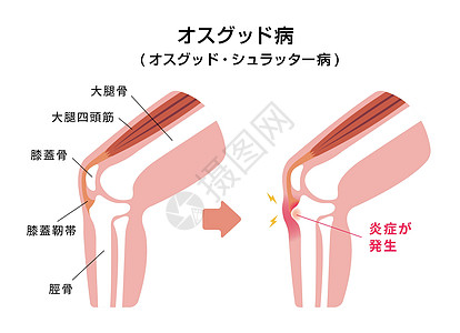 病膝关节病它制作图案胫骨生物学疾病伤害髌骨骨骼疼痛身体肌肉插图图片