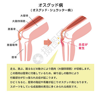 病膝关节病它制作图案伤害器官股骨疾病解剖学疼痛膝盖身体胫骨髌腱图片