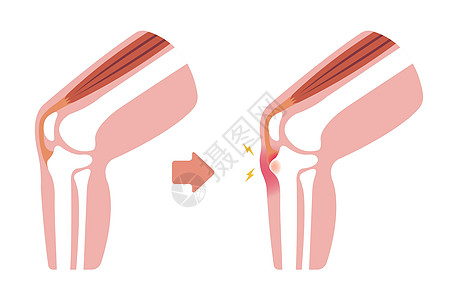 病膝关节病它制作图案股骨疼痛治疗疾病生物学伤害膝盖肌肉肌腱运动图片