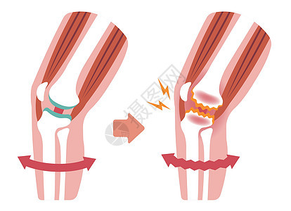 膝关节疼痛的机制和原因 膝关节炎 骨关节炎 膝关节 平面插图替代品器官保健膝关节病药品疾病股骨节炎膝盖科学背景图片