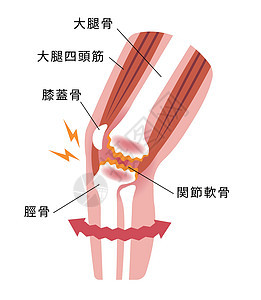 膝关节疼痛膝关节病骨关节炎膝关节病 平面插画卫生生物骨骼生物学女性替代品膝盖身体解剖学病人图片