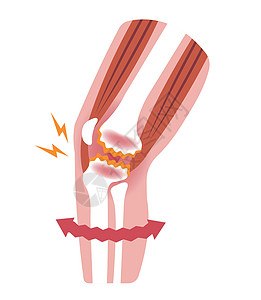膝关节疼痛膝关节病骨关节炎膝关节病 平面插画卫生女性关节替代品解剖学生物学股骨病人插图保健图片