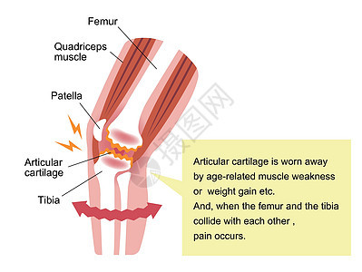 膝关节疼痛膝关节病骨关节炎膝关节病 平面插画膝盖骨骼骨科女士科学节炎骨关节炎衰变器官疼痛图片