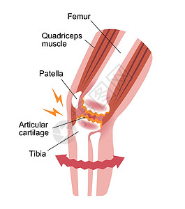 膝关节疼痛膝关节病骨关节炎膝关节病 平面插画女士生物学股骨解剖学骨关节炎插图保健关节身体骨骼图片