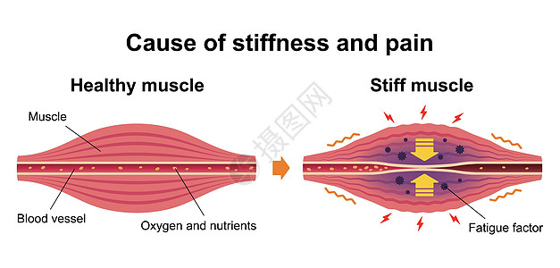 肌肉僵硬和疼痛圆圈类型它制作图案的过程身体疾病纤维按摩解剖学女士落枕药品肩膀器官图片