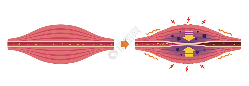 两种类型纤维肌肉僵硬和疼痛圆圈类型它制作图案的过程脖子身体组织痛苦疾病女士血管药品插图纤维插画