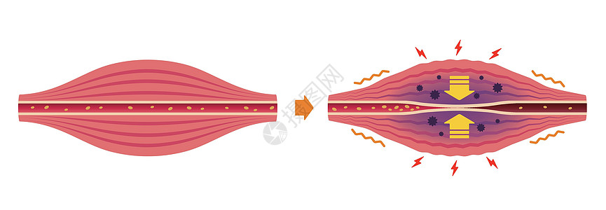 肌肉僵硬和疼痛圆圈类型它制作图案的过程脖子身体组织痛苦疾病女士血管药品插图纤维图片