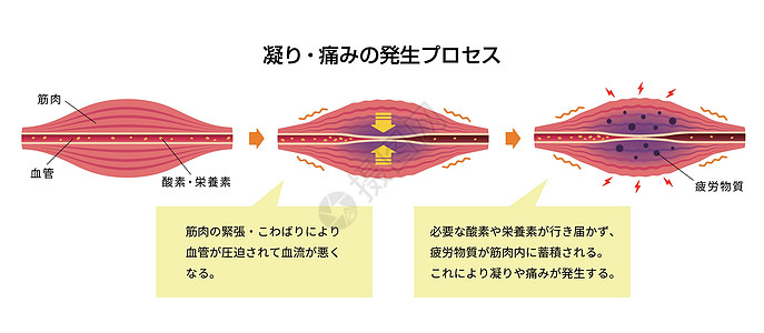 肌肉僵硬和疼痛圆圈类型它制作图案的过程科学生物学身体组织脖子药品器官解剖学女士落枕图片