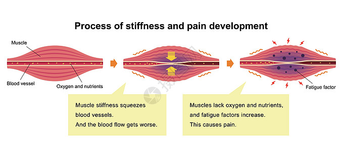 它制作图案的肌肉僵硬和疼痛的原因血管落枕按摩解剖学纤维疾病脖子痛苦器官科学图片