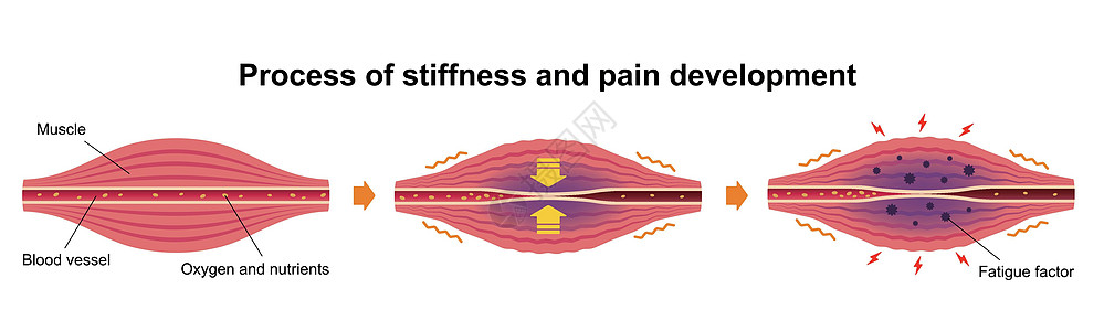 出现闷胀和疼痛 肌肉和血管的平面插图组织落枕科学解剖学纤维女士痛苦身体疾病肩膀图片