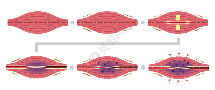 肌肉僵硬和疼痛圆圈类型它制作图案的过程器官女士药品痛苦插图纤维疾病脖子按摩生物学图片