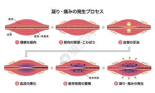 肌肉僵硬和疼痛圆圈类型它制作图案的过程痛苦解剖学插图脖子女士疾病身体按摩器官肩膀图片