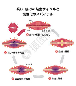 肌肉僵硬和疼痛圆圈类型它制作图案的过程按摩组织疾病纤维器官科学解剖学药品女士落枕图片
