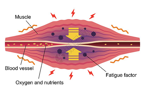 疲劳因素累积 肌肉和血管的平面插图疼痛纤维药品女士身体落枕疾病脖子科学组织图片