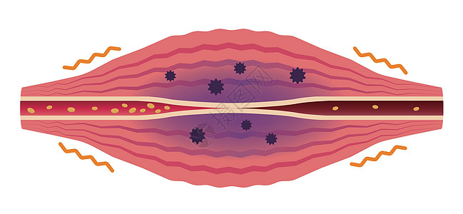 疲劳因素累积 肌肉和血管的平面插图身体组织肩膀解剖学脖子疼痛器官纤维科学女士图片