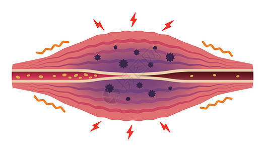 疲劳因素累积 肌肉和血管的平面插图落枕科学疼痛生物学疾病器官组织解剖学纤维药品图片