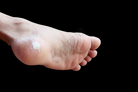 在黑色背景和剪切路径上隔离的紧闭止痛脚玉米烧伤疼痛疾病组织皮肤病变剪裁糖尿病伤害愈合图片