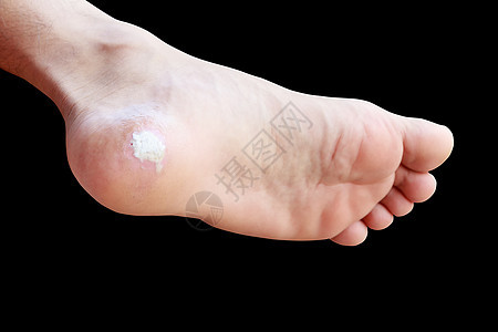 在黑色背景和剪切路径上隔离的紧闭止痛脚玉米愈合皮肤科烧伤痛苦创伤病变皮肤疼痛瘢痕疾病图片
