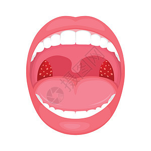 喉咙细菌和病毒感染扁桃体发炎链球菌咽炎感染医疗心绞痛插图解剖学组织药品腺体图片