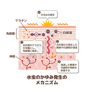 脚癣病媒制作图案的产生机制医院卫生身体治疗肿胀角质层伤口地层手指皮疹图片