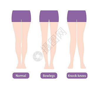 不同类型的腿部角度和膝盖矢量图解 正常保龄球腿外翻保健身体疼痛膝关节炎脚骨平衡治疗骨科外科股骨图片