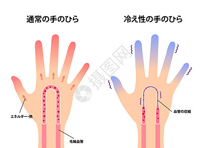 日本正常手和冷手对冷指尖敏感度比较图寒潮疼痛身体插图状况症状疾病成人手臂流感背景图片