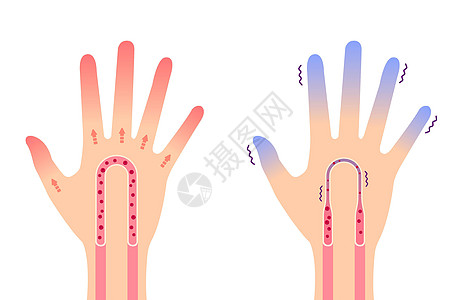正常手和冷手对寒冷指尖的敏感度对比图 no tex图片