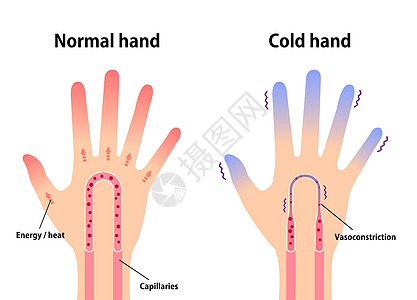 正常手和冷手对指尖冷的敏感度比较图卡通片手指血液循环蓝色女性状况疼痛疾病流感成人图片