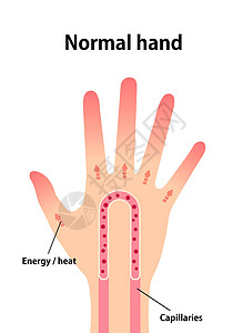 正常手部血液循环制作图案成人症状寒冷女士疼痛女性手臂疾病流感手指图片