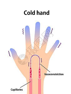 冷手血液循环图示对冷指尖的敏感性器官蓝色温度插图身体寒冷卡通片寒潮手指手臂背景图片